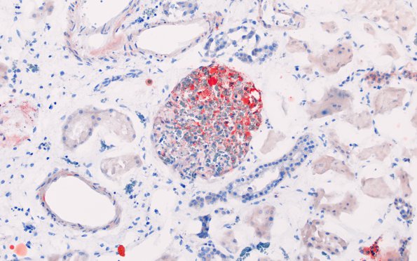 4G3 Embolism, fat (Case 4) Kidney ORO 3