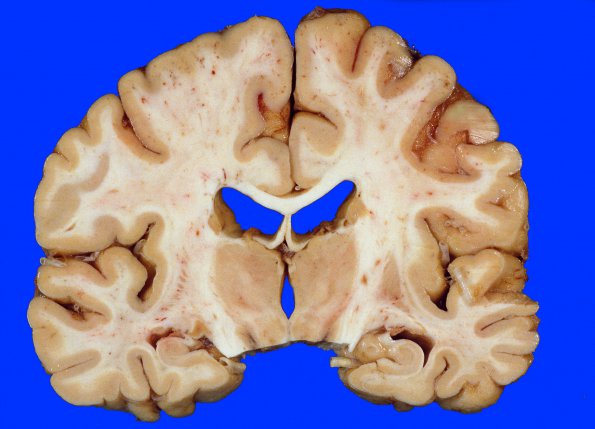 5A1 Fat Embolism (Case 5) 1