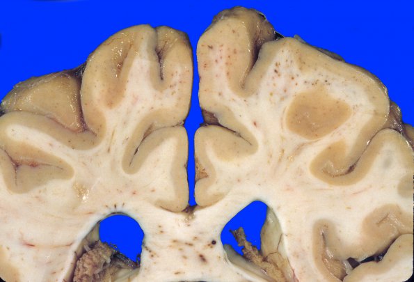 5A2 Fat Embolism (Case 5) 4A 5