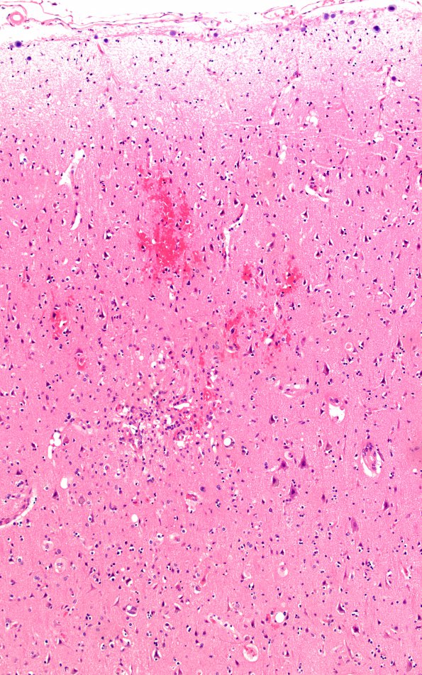 5B1 Fat Embolism (Case 5) N1 1