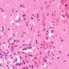 5B2 Fat Embolism (Case 5) N1 2 copy