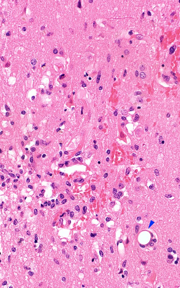 5B2 Fat Embolism (Case 5) N1 2 copy