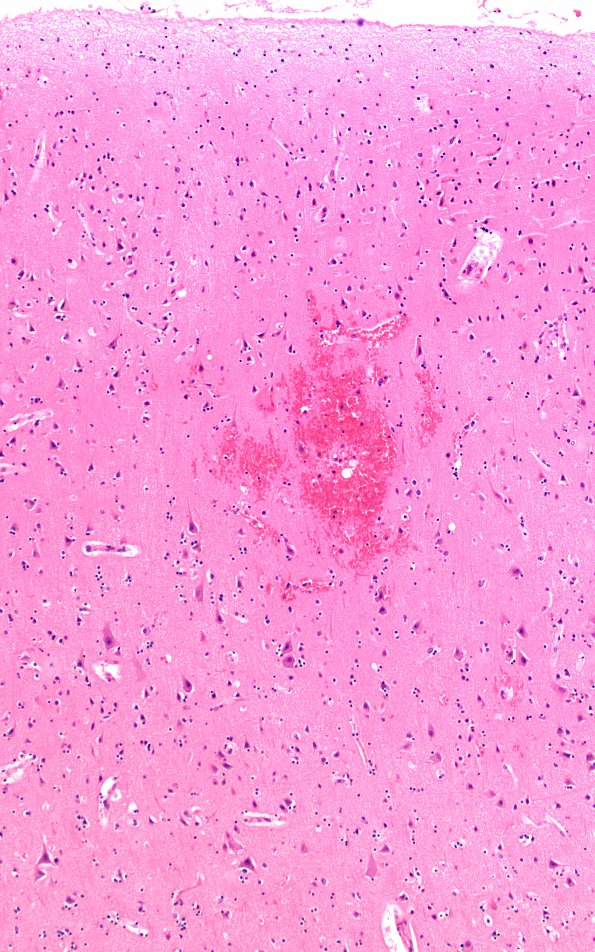 5B3 Fat Embolism (Case 5) N1 4