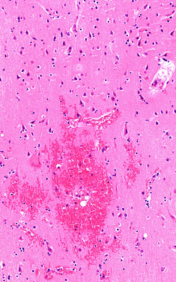 5B4 Fat Embolism (Case 5) N1 3