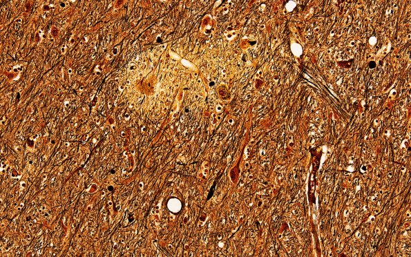 5C1 Fat Embolism (Case 5) N6 Biels 1