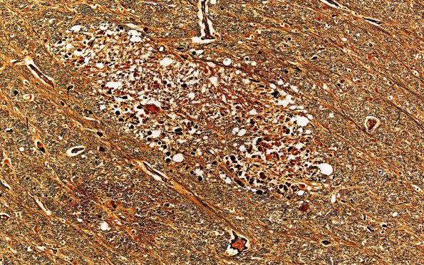 5C2 Fat Embolism (Case 5) N6 Biels 2