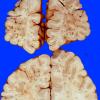 6A1 Embolism, Fat (Case 6) 2