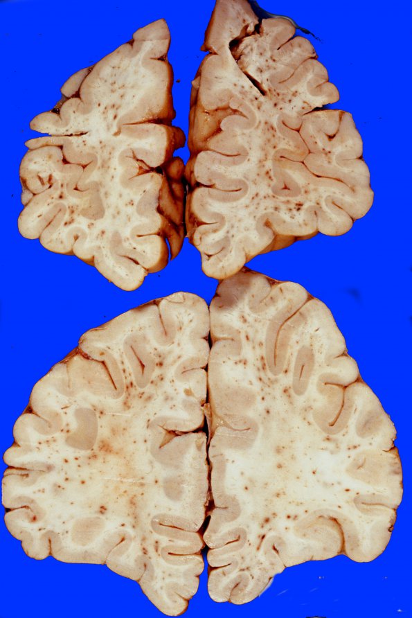 6A1 Embolism, Fat (Case 6) 2