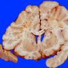 6A2 Embolism, Fat (Case 6) 1