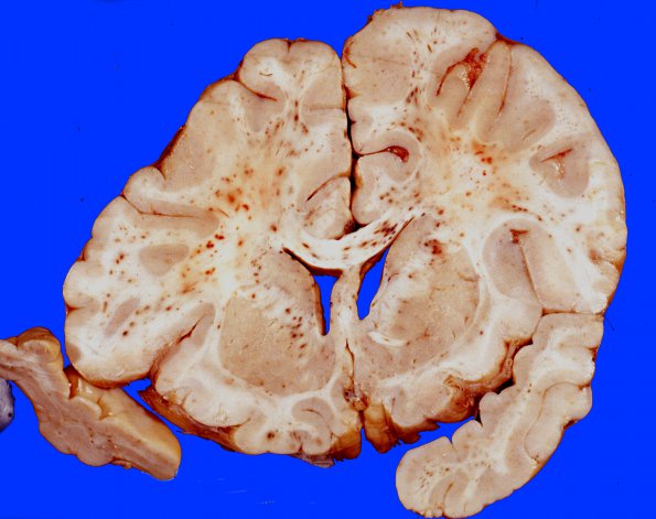 6A2 Embolism, Fat (Case 6) 1