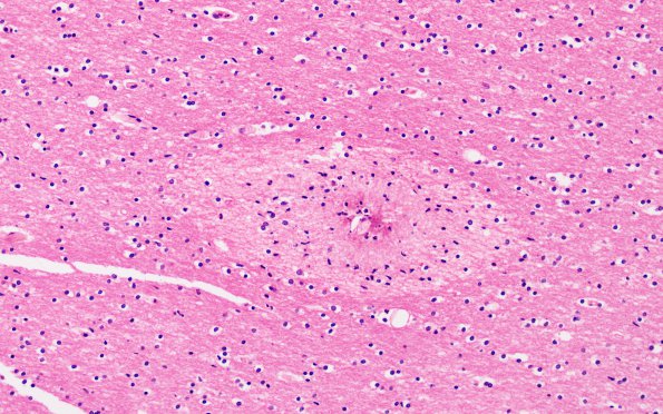 6B1 Embolism, Fat (A26560) H&E 40X