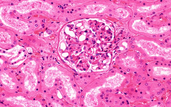 6C Embolism, Fat (A26560) H&E 40X glomerulus