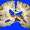 7A1 Embolism, fat & Hypoxic-Ischemic encephalopathy (Case 7) _5