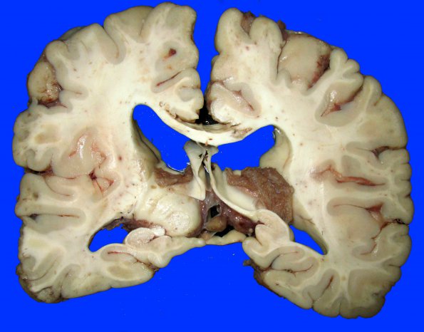 7A1 Embolism, fat & Hypoxic-Ischemic encephalopathy (Case 7) _5