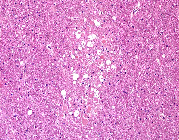 7B1 Embolism, fat (Case 7) H&E 3