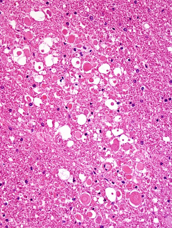 7B2 Embolism, fat (Case 7) H&E 4