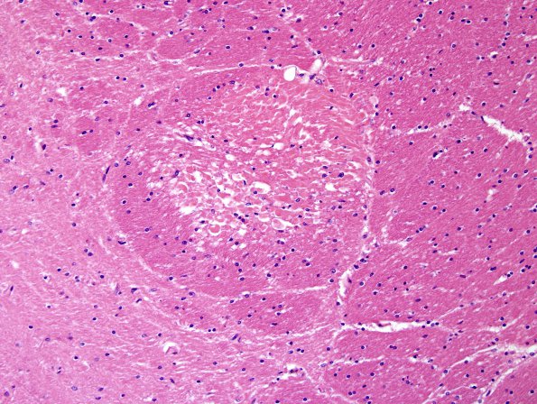 7B3 Embolism, fat (Case 7) N6 H&E 1