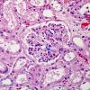 7C Embolism, fat & Hypoxic-Ischemic encephalopathy (Case 7) Kidney 1 copy