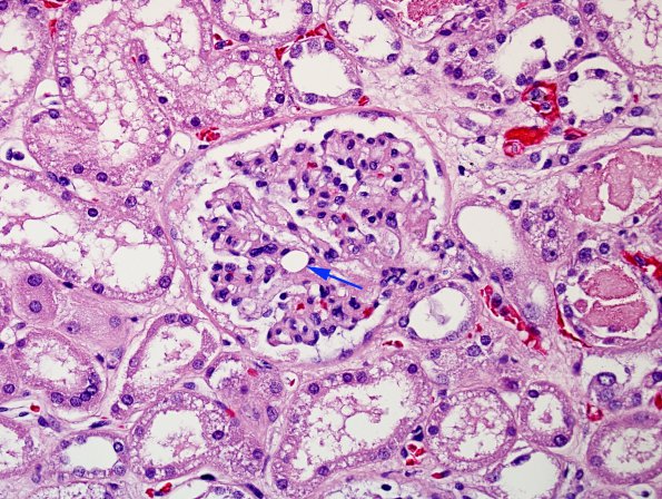 7C Embolism, fat & Hypoxic-Ischemic encephalopathy (Case 7) Kidney 1 copy