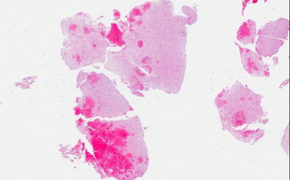 8A1 Embolism, fat & sickle cell & Bone Marrow Infarcts (AANP 2013 Case 4) H&E 2.1X