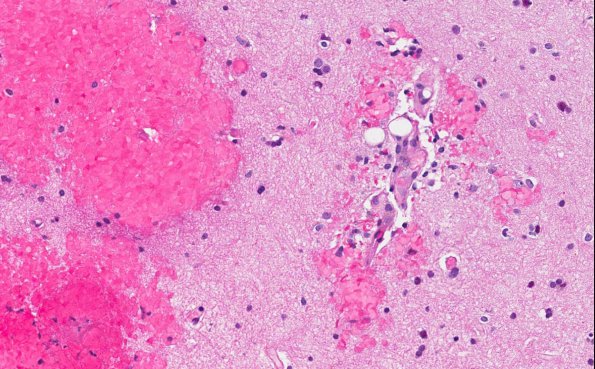 8A2 Embolism, fat & sickle cell & Bone Marrow Infarcts (AANP 2013 Case 4) H&E 30.6X 2