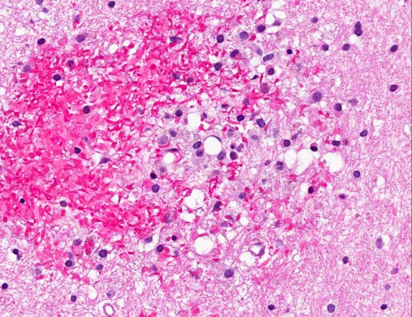 8A4 Embolism, fat & sickle cell & Bone Marrow Infarcts (AANP 2013 Case 4) H&E 4