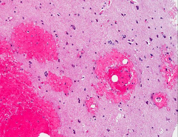 8A5 Embolism, fat & sickle cell & Bone Marrow Infarcts (AANP 2013 Case 4) H&E 2