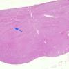 9A1 Embolism, fat, pancreatitis (AANP 2012 Case 4) H&E whole mount copy