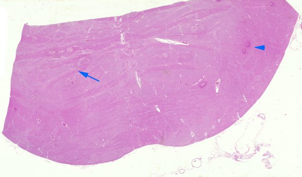 9A1 Embolism, fat, pancreatitis (AANP 2012 Case 4) H&E whole mount copy