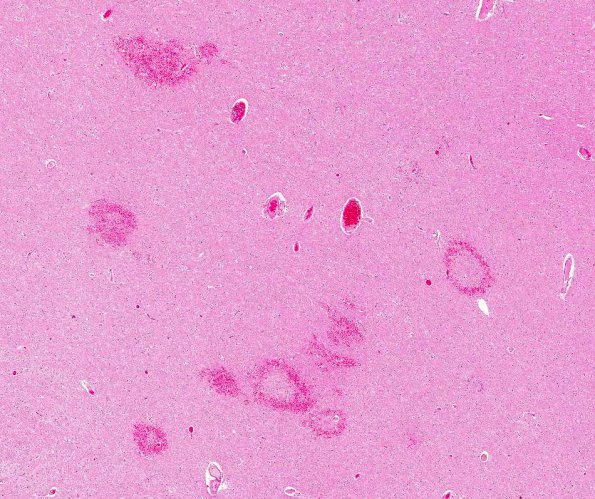 9A2 Embolism, fat, pancreatitis (AANP 2012 Case 4) H&E 1.5X