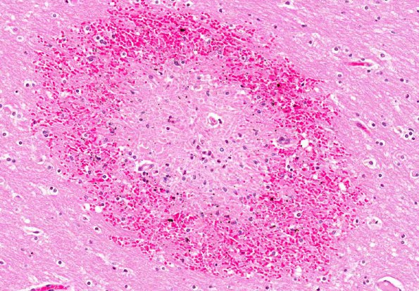 9A3 Embolism, fat, pancreatitis (AANP 2012 Case 4) H&E 17.6X