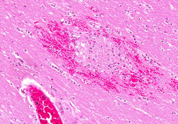 9A4 Embolism, fat, pancreatitis (AANP 2012 Case 4) H&E 20X 1