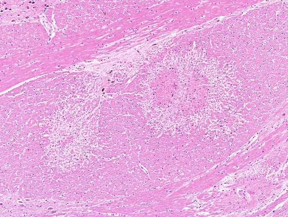 9A5 Embolism, fat, pancreatitis (AANP 2012 Case 4) H&E 4