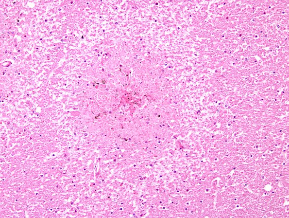 9A6 Embolism, fat, pancreatitis (AANP 2012 Case 4) H&E 1