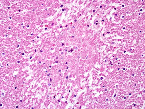 9A7 Embolism, fat, pancreatitis (AANP 2012 Case 4) H&E 5