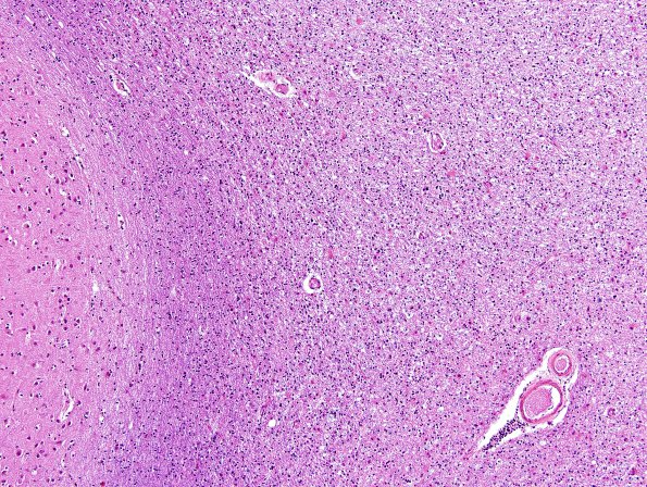 1B3 Leukoencephalopathy, delayed post-hypoxic (AANP 2013 Case 2) H&E-LFB 2A