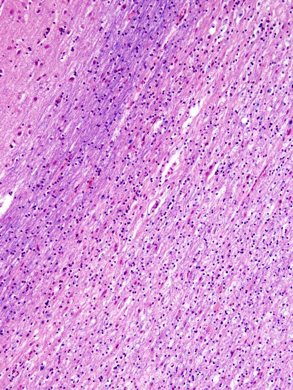 1B4 Leukoencephalopathy, delayed post-hypoxic (AANP 2013 Case 2) H&E-LFB 8