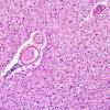 1B5 Leukoencephalopathy, delayed post-hypoxic (AANP 2013 Case 2) H&E-LFB 3A