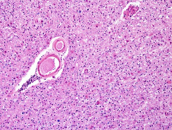 1B5 Leukoencephalopathy, delayed post-hypoxic (AANP 2013 Case 2) H&E-LFB 3A