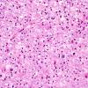 1B6 Leukoencephalopathy, delayed post-hypoxic (AANP 2013 Case 2) H&E-LFB 4A