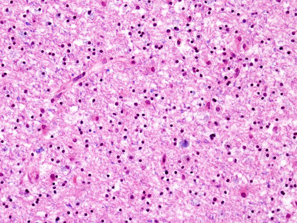 1B6 Leukoencephalopathy, delayed post-hypoxic (AANP 2013 Case 2) H&E-LFB 4A