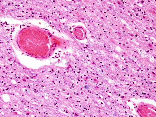 1B7 Leukoencephalopathy, delayed post-hypoxic (AANP 2013 Case 2) H&E-LFB 10