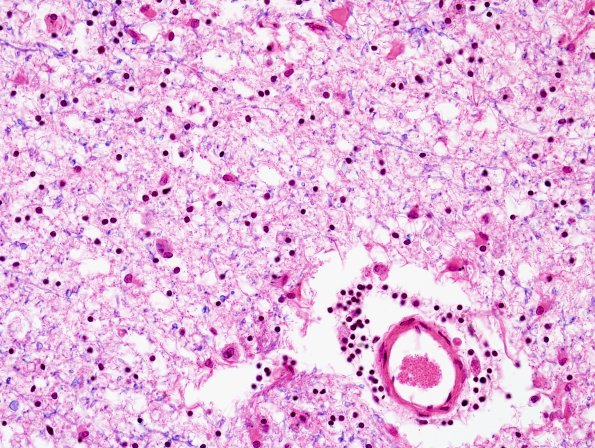 1B8 Leukoencephalopathy, delayed post-hypoxic (AANP 2013 Case 2) H&E-LFB 14