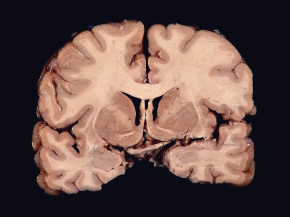 2A1 Hypoxia-Ischemia White Matter Adult (Case 2) 1