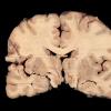 2A2 Hypoxia-Ischemia White Matter Adult (Case 2) 2