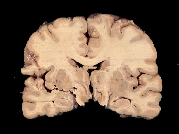 2A2 Hypoxia-Ischemia White Matter Adult (Case 2) 2