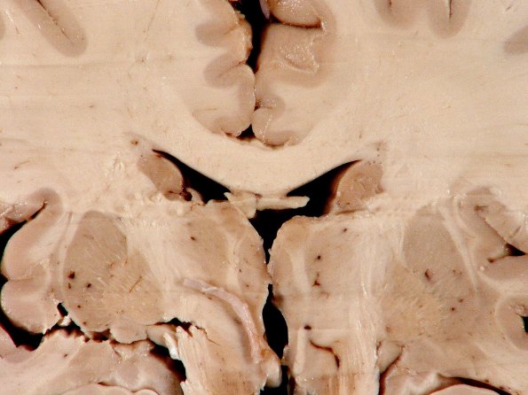 2A3 Hypoxia-Ischemia White Matter Adult (Case 2) 3