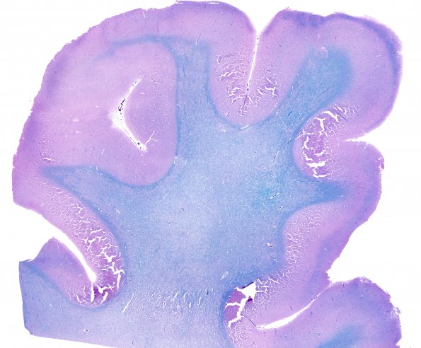 2B2 Hypoxia-Ischemia Adult White Matter (Case 2) 1 LFB-PAS whole mount