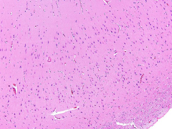 2C2 Hypoxia-Ischemia Adult White Matter (Case 2)  Sommer's sector H&E 1