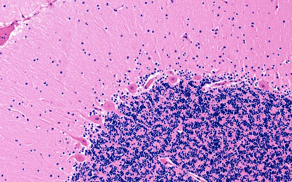 2C3 Hypoxia-Ischemia Adult White Matter (Case 2) N9 H&E 20X